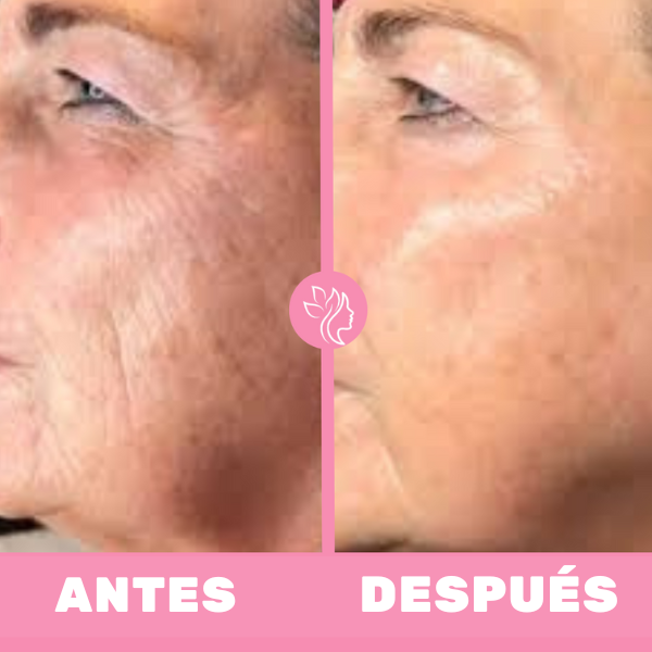 ANTES-_15_